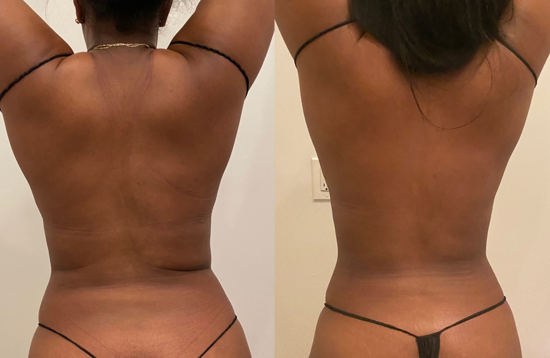 Bodysculptingbyla In Rockville Centre NY | Vagaro